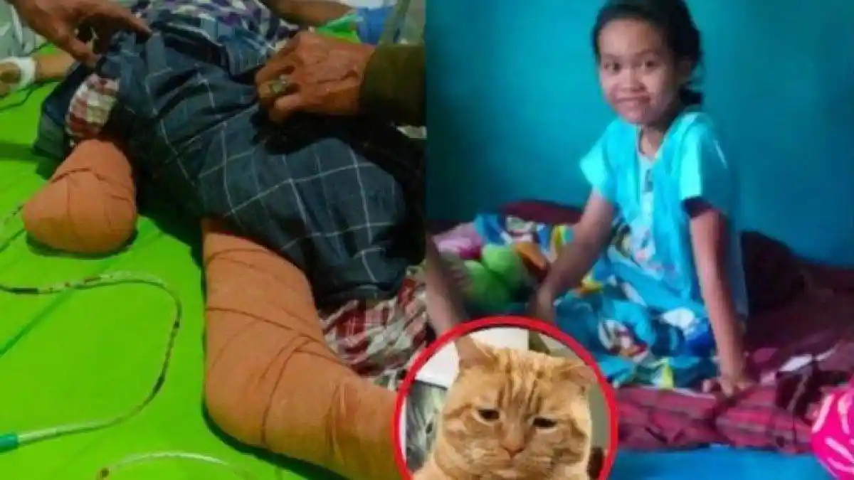 Viral Kisah Nabila, Bocah SD Terlindas Truk hingga Kehilangan Kakinya Demi Selamatkan Kucing