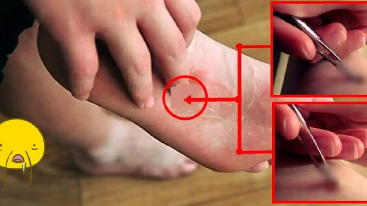 Ada Lubang Kecil di Kaki Wanita ini, Saat Isinya Dikeluarkan Bikin Semua Orang Syok