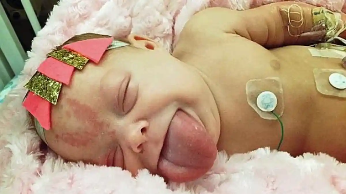 Agar Tetap Hidup, Lidah Bayi Ini Harus Dipotong dan Kini Sudah Bisa Tersenyum