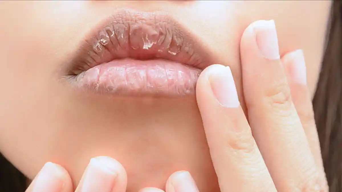 8 Tips Jaga Kesehatan Bibir Saat Cuaca Sedang Dingin Agar Tidak Kering dan Mengelupas