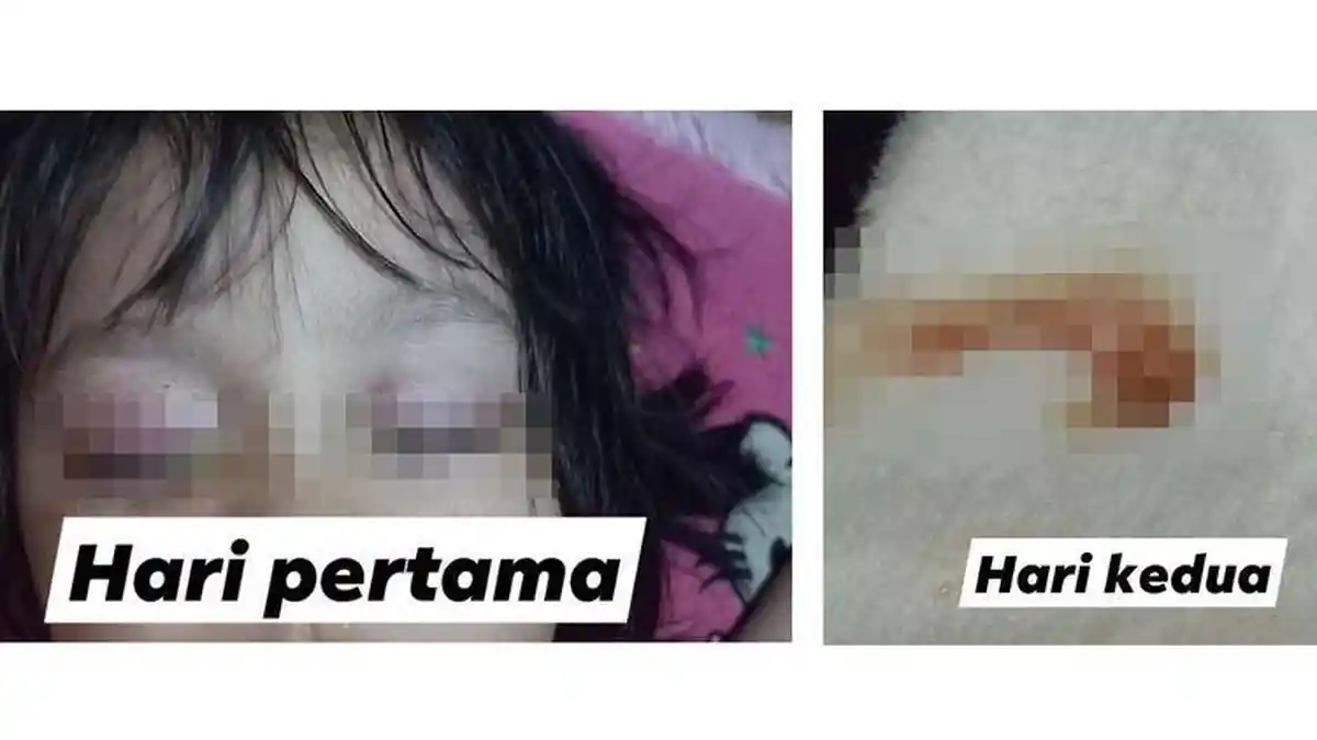 POPULER: Viral, Mata Anak Keluar Cairan Mirip Darah dan Nanah Akibat Radiasi HP, Ini Kata Dokter