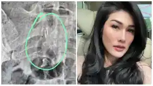 Sebelum-Stevie-Agnecya-meninggal-ia-sempat-mengunggah-bukti-rontgen-yang-mengejutkan.jpg