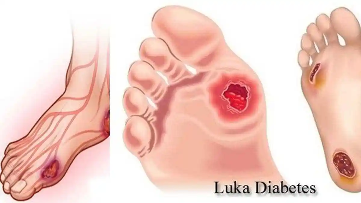 Simak 6 Cara Menangani Luka Pada Kaki Bagi Penderita Diabetes Berikut Ini