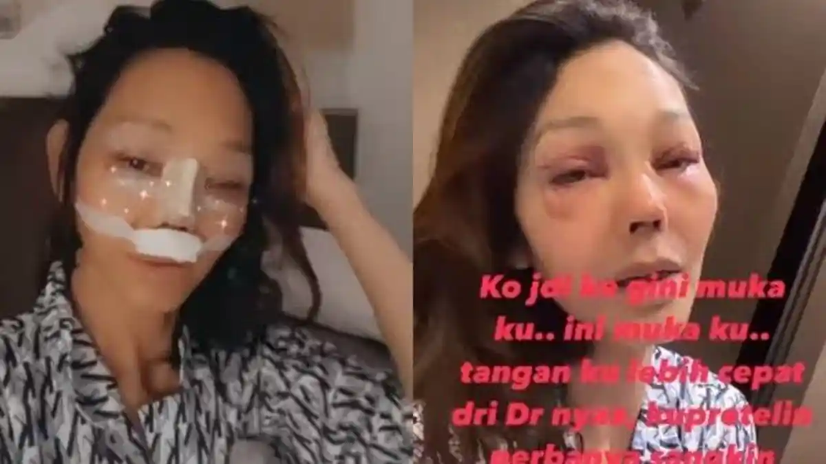 Bengkak! Penampakan Wajah Bunda Corla Seusai Operasi Plastik, ini Kata Dokter
