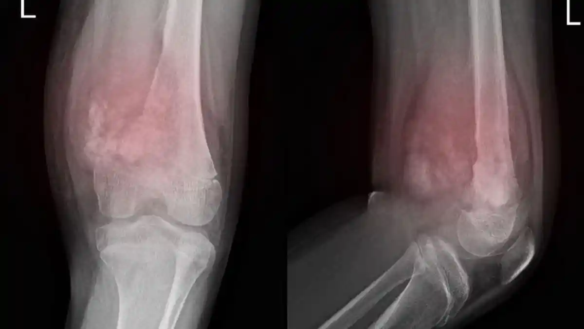 Apa itu Osteosarkoma? Penyakit Kanker yang Sering Menyerang Remaja
