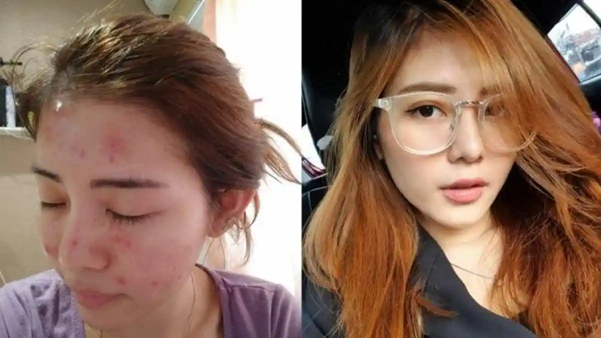 Youtuber Ini Berbagi Pengalamannya Cari Solusi Atasi Jerawat yang jadi Masalahnya Sejak 8 Tahun