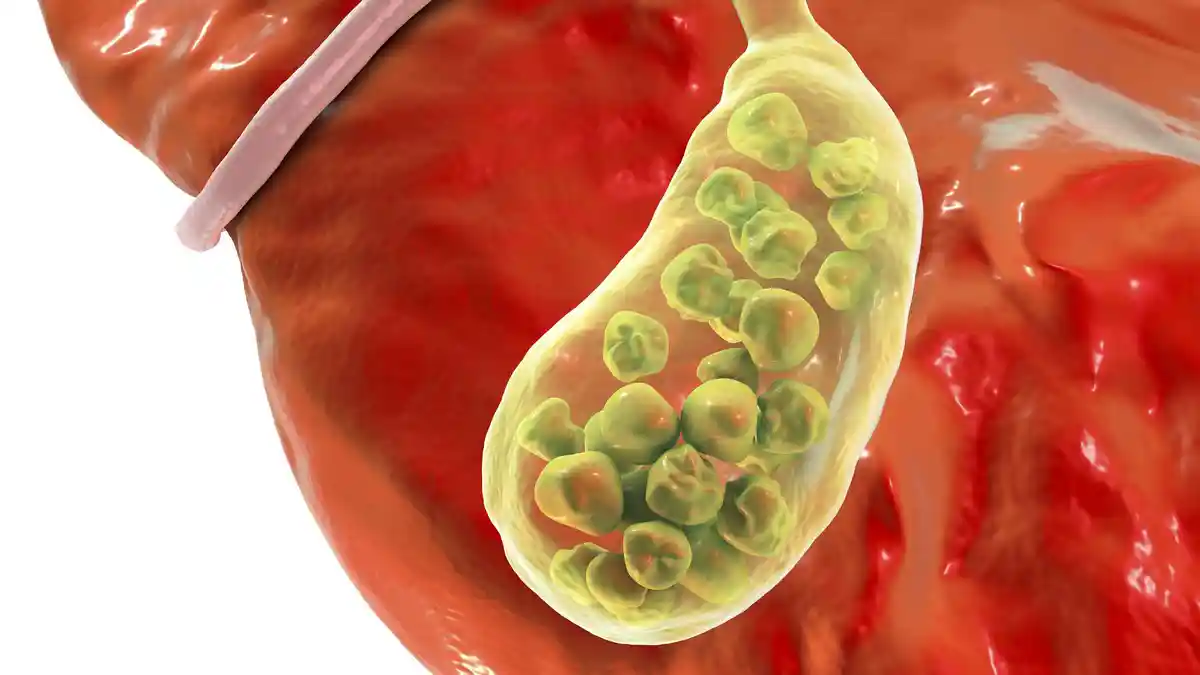 Gejala dan Faktor Risiko Penyakit Batu Empedu (Cholelithiasis) yang Perlu Diwaspadai