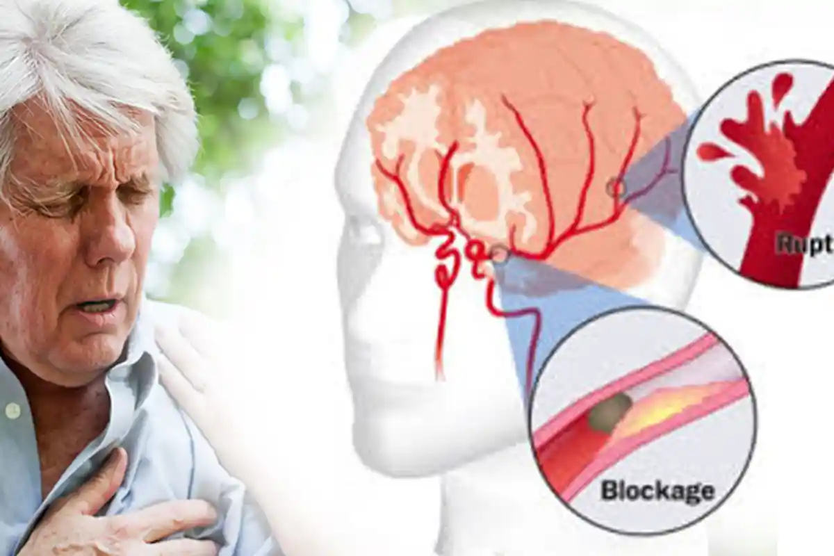 Jadi Penyebab Terkena Stroke, Berikut Cara Mengontrol Stres untuk Cegah Stroke