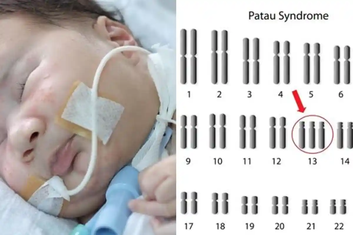 Bayi Adam Fabumi Meninggal - Bisakah Penyakit Langka Trisomi 13 Dicegah Selama Kehamilan?
