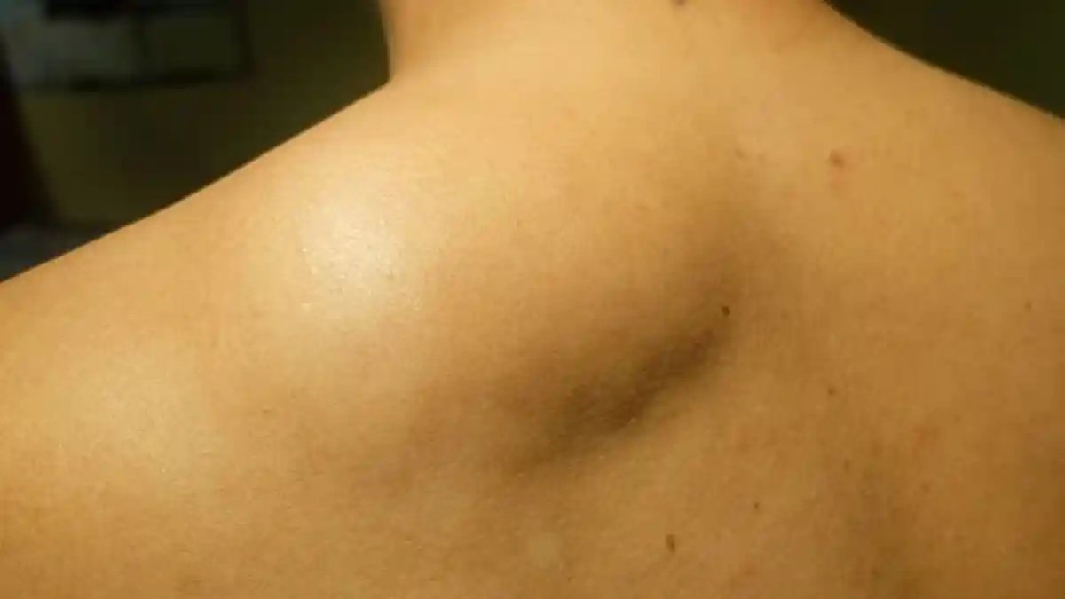 Mengenal Lipoma, Benjolan di Bawah Kulit yang Lunak Hingga Bisa Digerakkan, Perlukah Operasi?