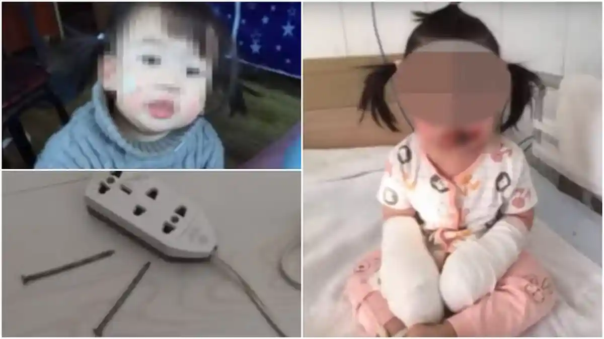 Miris, Ibu Tak Tahu Bayi 2 Tahun Tersetrum Setelah Main Stop Kontak dengan Paku, Terbakar Parah
