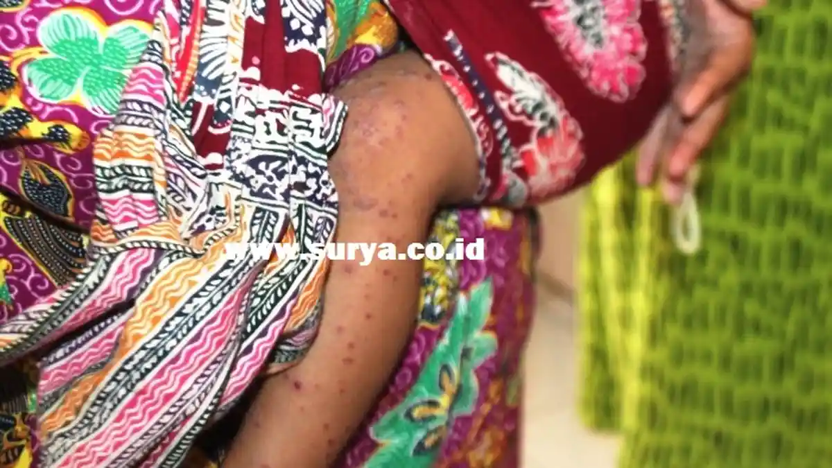 Flu Singapura Kembali Mewabah di Blitar, Serang 261 Anak