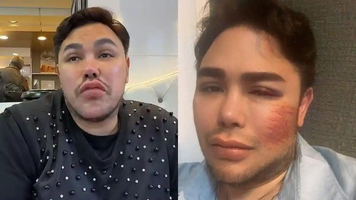 Terjawab Penyebab Wajah Ivan Gunawan Bonyok, Rekan Artis sampai Kaget, Ferry Irawan: Astaghfirullah
