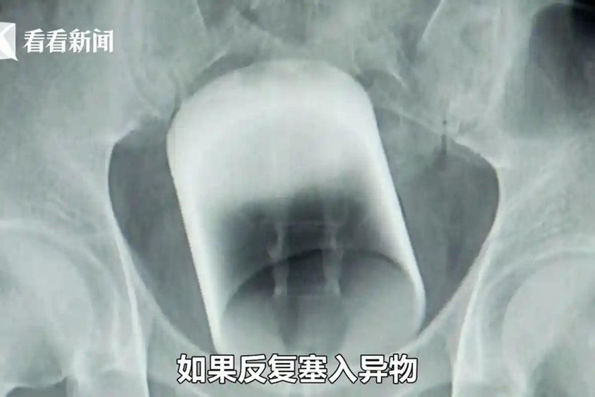 Kok Bisa? Dokter Terkejut Temukan Cangkir Kaca Terjebak di Bokong Pria ini