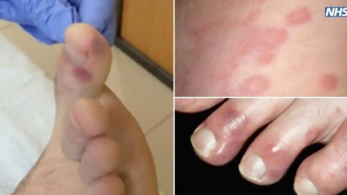 Perlu Diwaspadai, Ini 5 Kondisi Kulit yang Dikaitkan sebagai Gejala Virus Corona