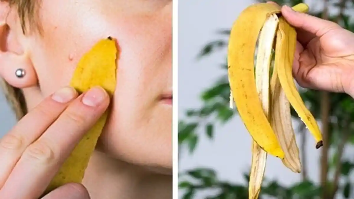 JERAWAT - Cara Mengatasi Jerawat, Manfaat Kulit Pisang dan Tips Merawat Kecantikan Wajah
