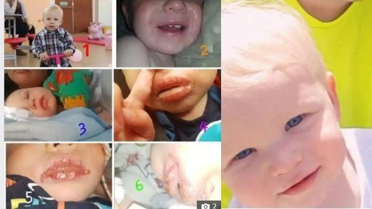 Kisah Sedih Bayi Kena Herpes Gara-gara Diciumi Orang Asing, Nyaris Meninggal