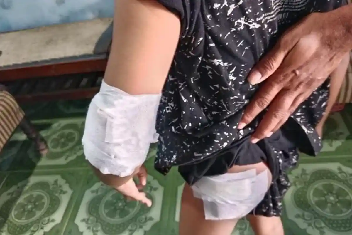 Anak 6 Tahun Diserang Monyet Liar di Jombang, Alami Luka Serius