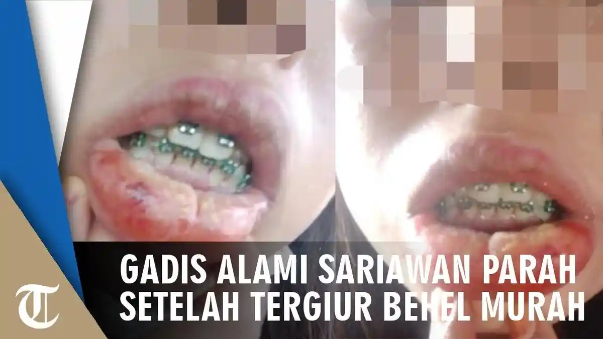 Ikutan Tren dan Tergiur Behel Murah, Gadis Alami Sariawan Parah, Bibir Bengkak hingga Deman Tinggi