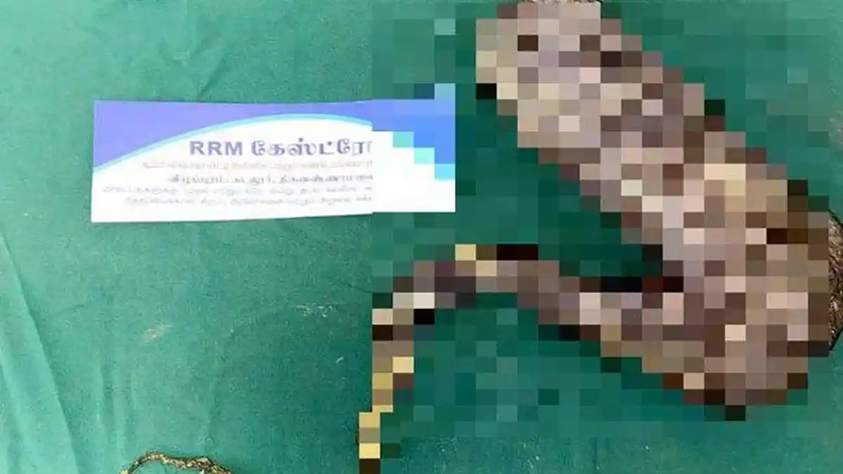 Dokter Mengira Benda 1,5 Kg di Perut Gadis Ini Tumor, Tapi Ternyata Segumpal Rambut