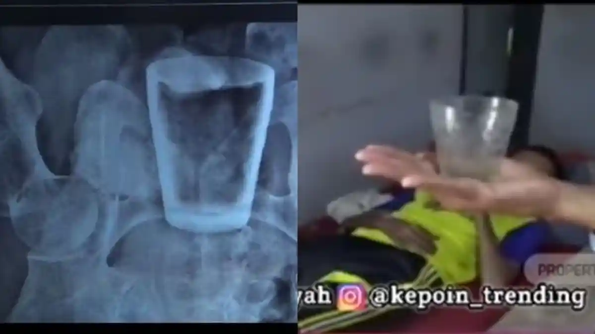 Aneh Tapi Nyata, Ada Gelas di Dalam Perut Seorang Pria, Berawal Nyeri Ulu Hati, 3 Bulan Terbaring