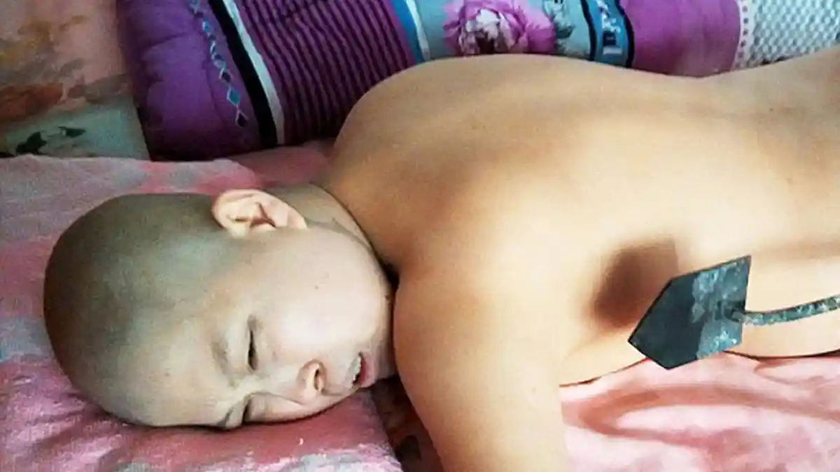 Kehabisan Biaya, Perempuan Ini Gunakan Besi Panas untuk Obati Kankernya - besi-panas-obati-kanker_20160322_152134.jpg