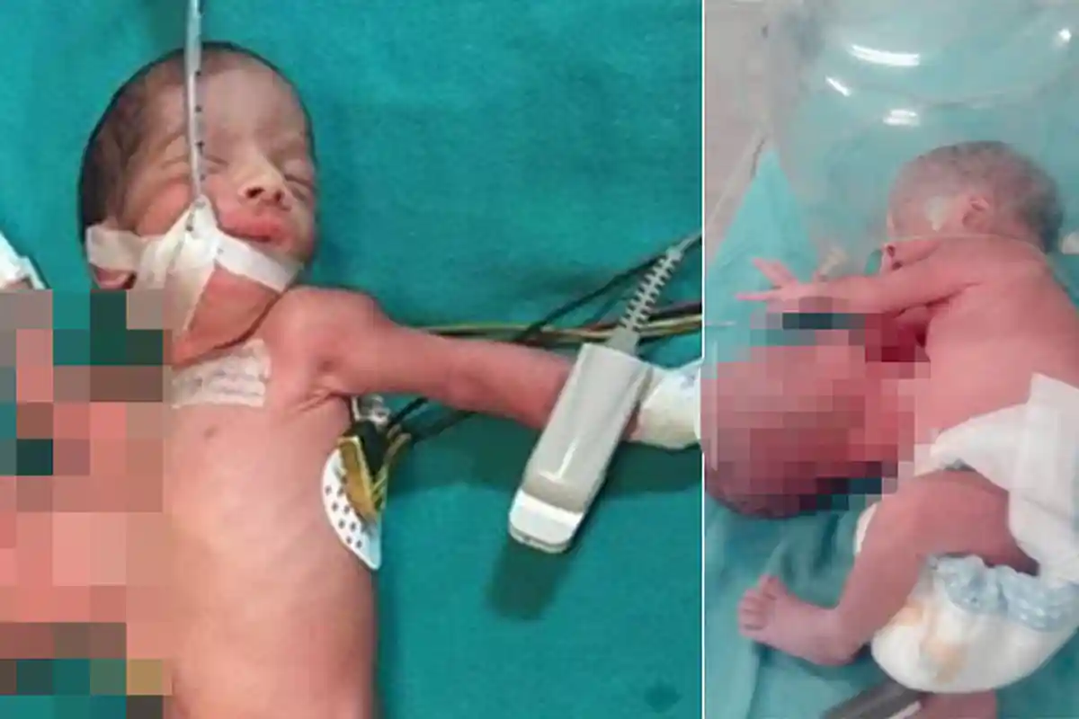 Dokter Operasi Caesar Kaget Bukan Main Lihat Sesuatu yang Menempel di Perut Bayi Saat Keluar Rahim