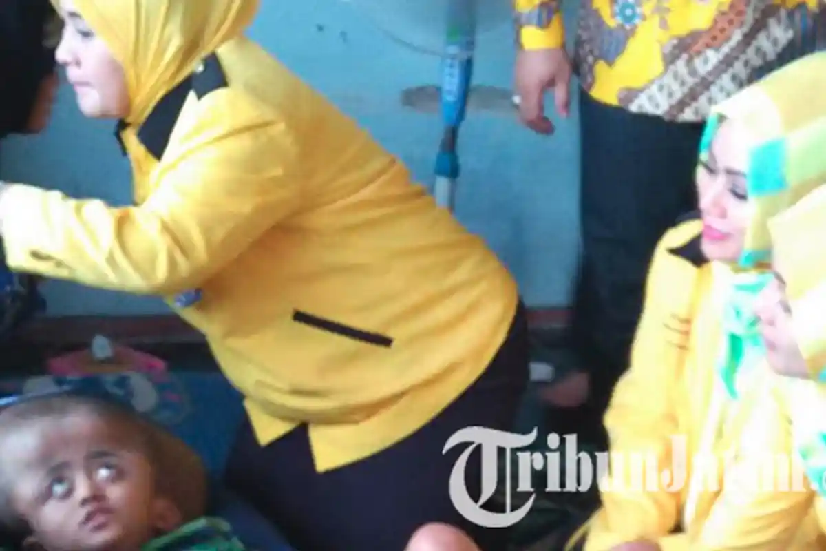 Nestapa Bilal, Mengidap Hidrosefalus Sejak Lahir 12 Tahun Lalu