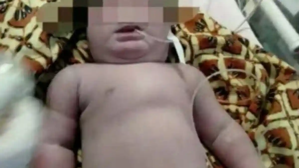 BAYI BERMATA SATU (Cyclopia) di Riau hanya Bertahan 2 Jam setelah Lahir, Ini Penjelasan Dokter