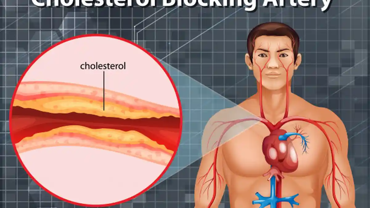 Jangan Makan 10 Jenis Makanan Ini Jika Tak Ingin Kelebihan Kolesterol 