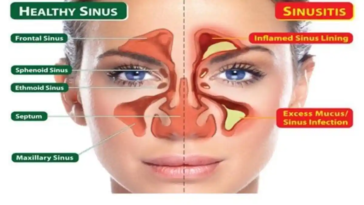 Sering Alami Hidung Tersumbat? Hati-hati Kena Sinusitis, Kenali Penyebab dan Penanganannya
