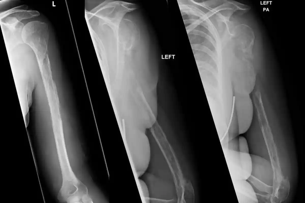 Jika Anda Melakukan Hal ini Ada Dampak Buruk yang Akan Terjadi Pada Tulangmu