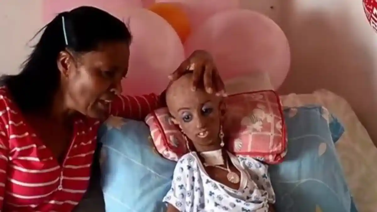 Kisah Pilu Gadis Remaja Umur 15 tahun seperti Nenek Renta Berusia 90 tahun