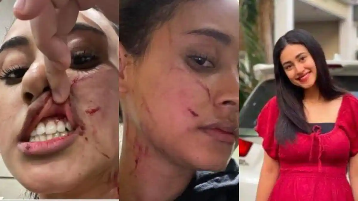 PILU Selebgram Afifah Riyad Dianiaya Mantan Pacar Suami, Wajah Penuh Cakaran & Jahitan Caesar Memar