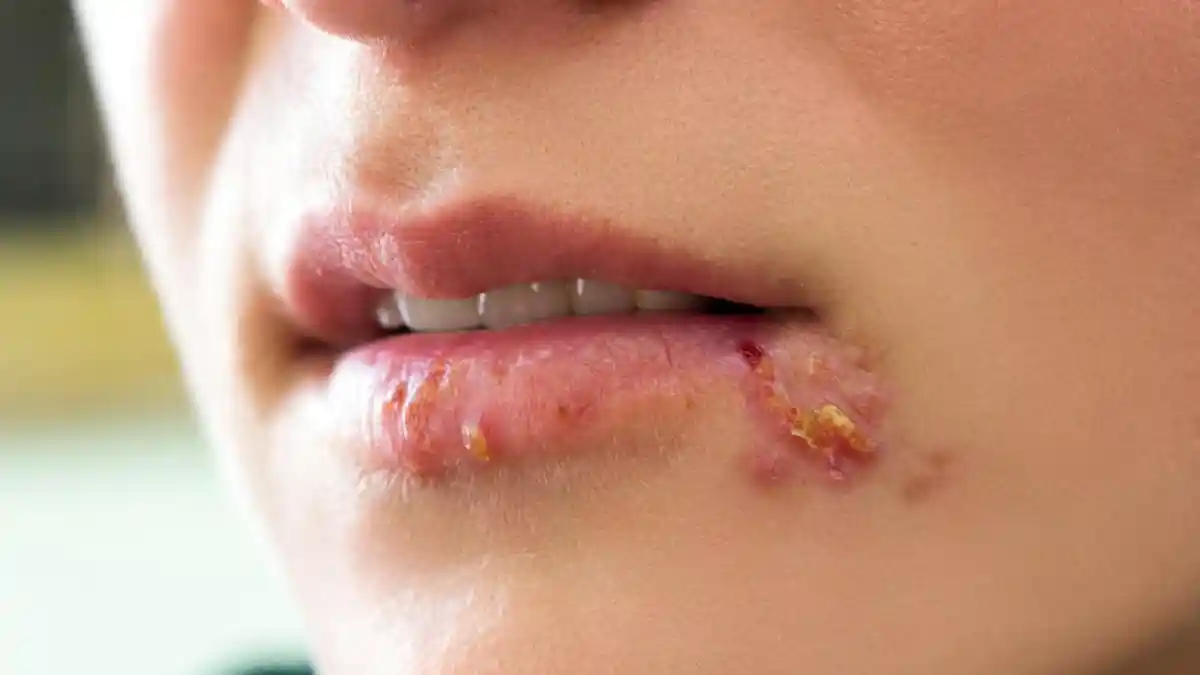 Disebabkan oleh Virus, Apa Itu Herpes Labialis? Waspada bila Muncul Luka di Sekitar Bibir