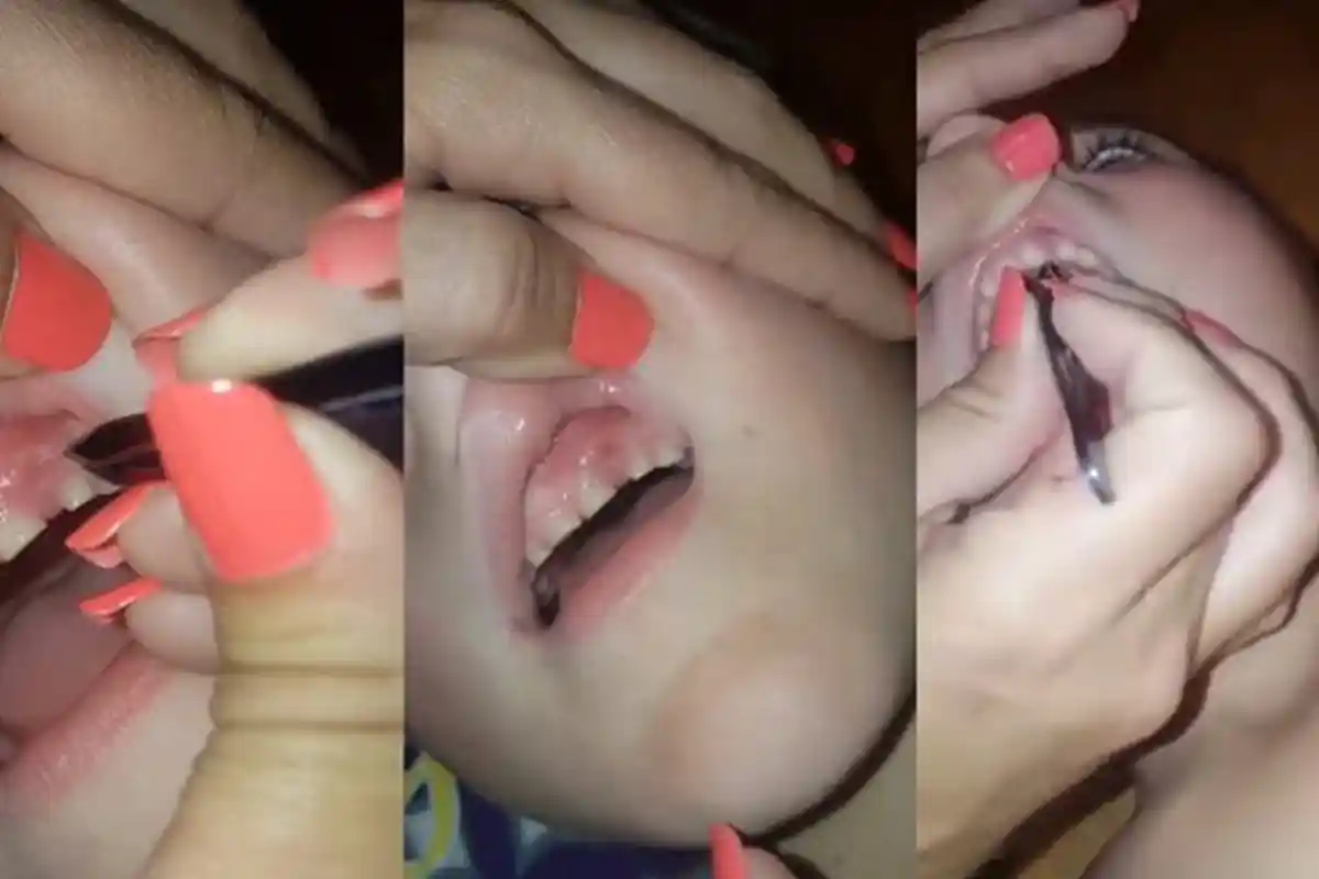 Ngeri, Ini yang Didapat Seorang Ibu dari Gusi Anaknya yang Suka Menggigit Kuku