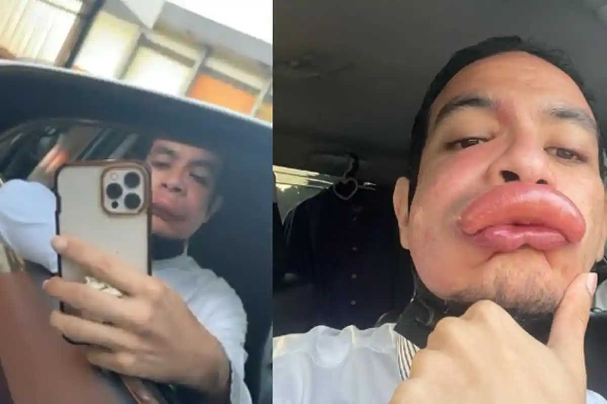 Cuci Muka Pagi Hari, Aktor Ini Menjerit Setelah Pakai Handuk, Bibirnya Berubah Jontor: Bukan Filter!