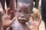 monkeypox-singapore.jpg