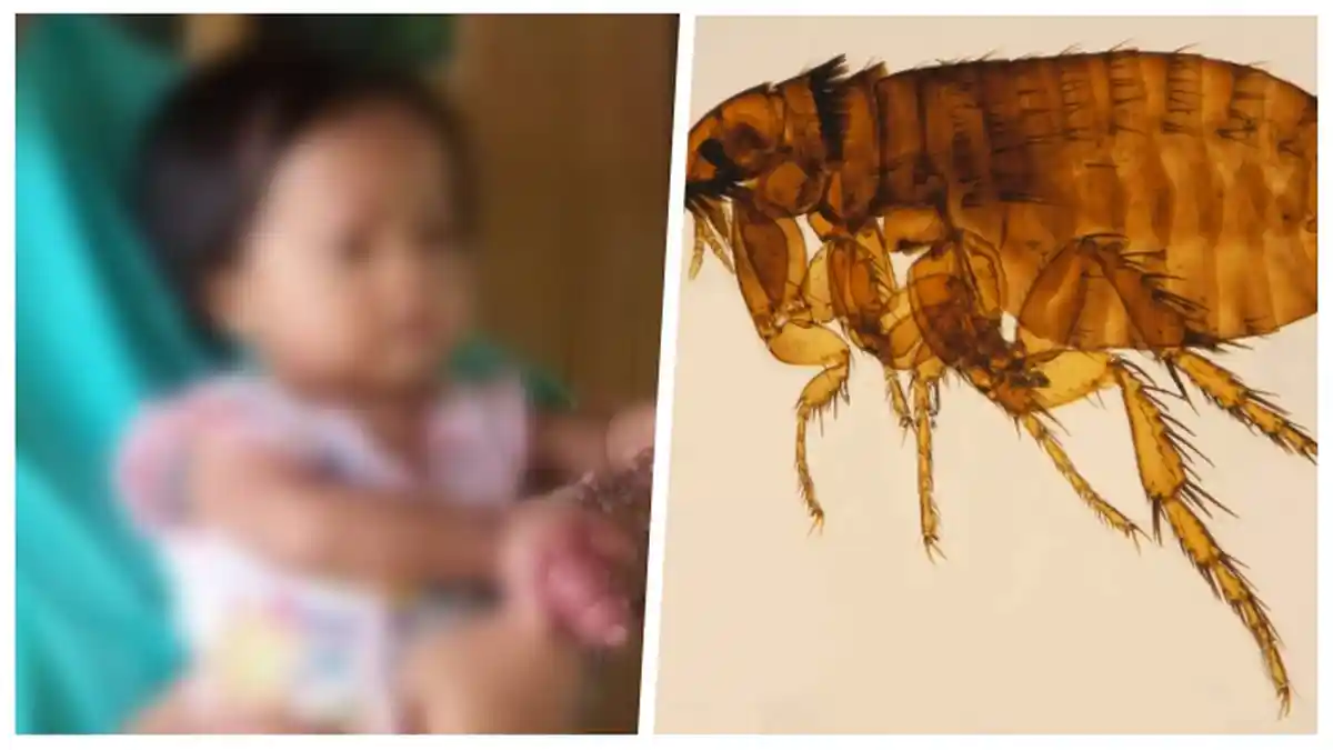 Waspada! Lantaran Digigit Kutu Kucing Sejak Usia 4 Bulan, Jari Bocah Ini Terancam Diamputasi
