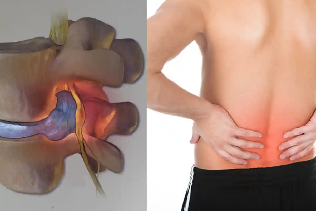 Kenali Apa itu Saraf Kejepit dan Cara Penanganan yang Tepat, Berikut Penjelasan Dokter Ortopedi