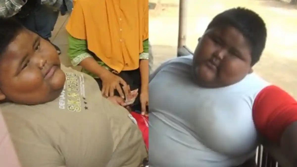 Satia Putra, Bocah Obesitas Asal Karawang Meninggal Dunia, Begini Kronologinya, Makan Sehari 7 Kali