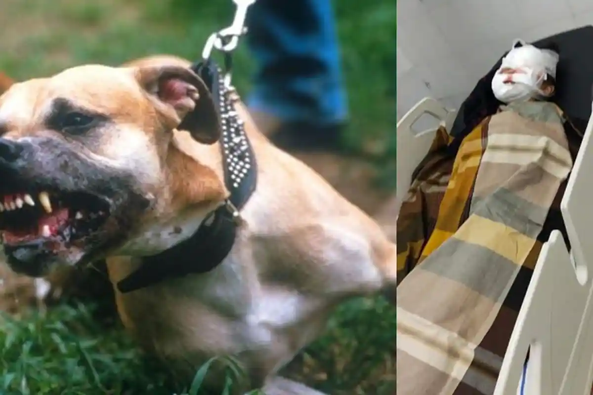 BREAKING NEWS: Bocah 8 Tahun Digigit Anjing Pitbull Hingga Wajahnya Luka Serius di Medan