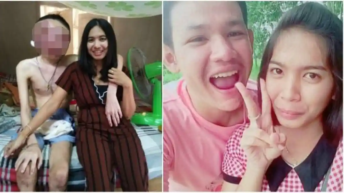 Kena Kanker Mata Ganas, Wajah Pacarnya Rusak Parah, Gadis Ini Ambil Keputusan yang Mengharukan