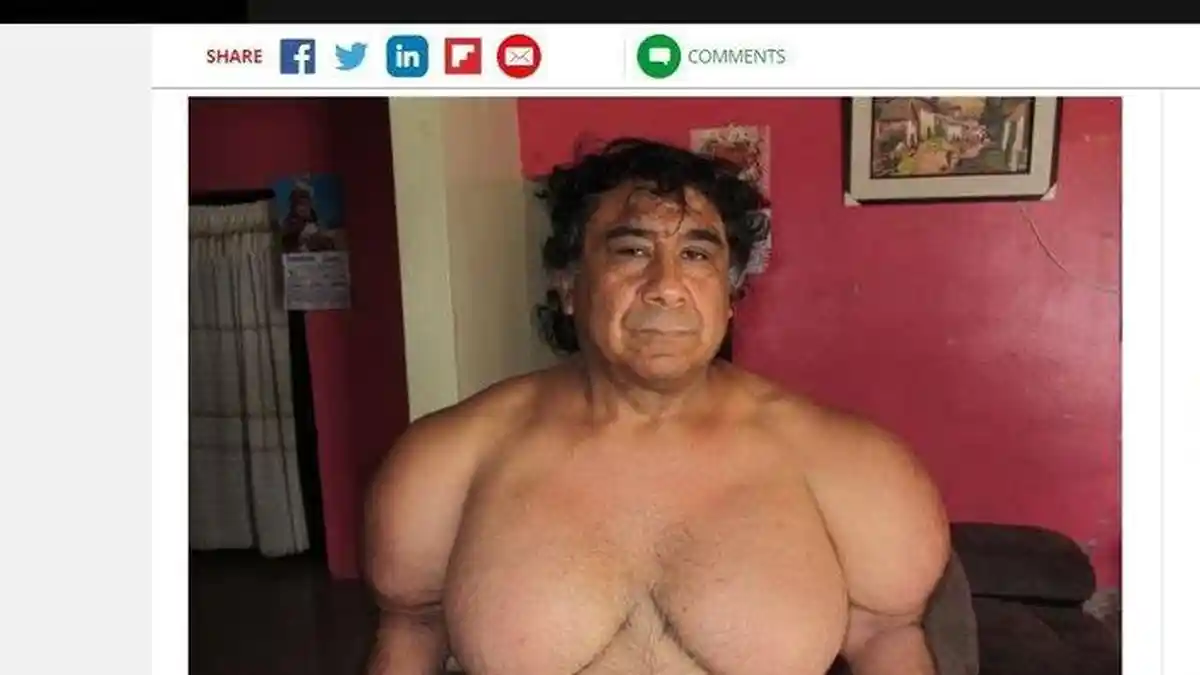 Tubuhnya Tiba-tiba Kekar Mirip Popeye, Pria Ini Malu Keluar Rumah karena Sering Diejek