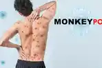 monkeypox-atau-cacar-monyet.jpg