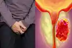 Ilustrasi-kanker-prostat.jpg