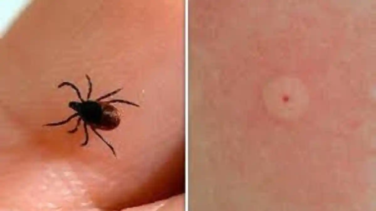 Ada Ruam di Kulit? Bisa Jadi itu Gejala Penyakit Lyme, Kenali Tahapan Infeksi dan Cara Mengobatinya