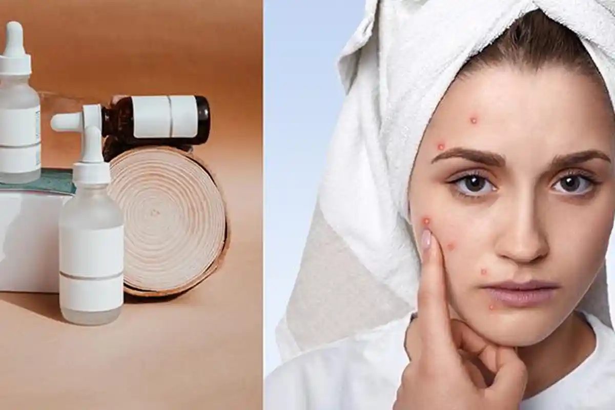 Muncul Jerawat dan Gangguan Kulit Wajah Setelah Coba Skincare Baru, Purging atau Breakout?