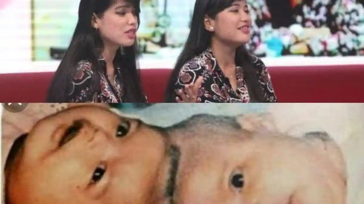 Ingat Yuliana Yuliani? Bayi Kembar Siam Pertama Berhasil Dioperasi di Indonesia, Begini Kabarnya