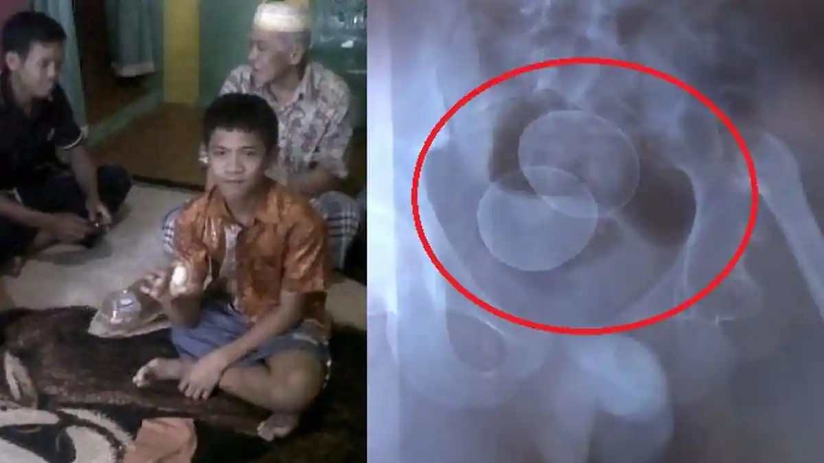Fakta Bocah Bertelur di Sulsel, dari Telur Ayam sampai Jumlahnya yang 21 Butir